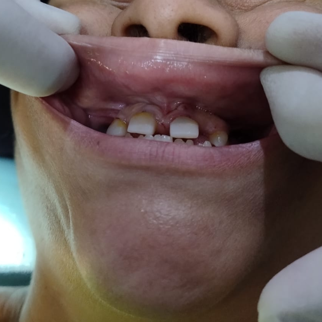 Procedimento realizado pela equipe OdontoCompany Três Corações